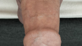 Beringter Penis