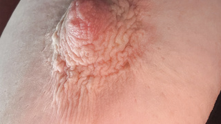 Meine Nippel nach dem Schröpfglas