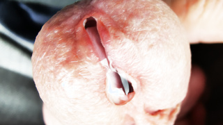 Dilator, wo das Sperma sprudeln kann