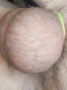 Dicker abgebundener Hoden.