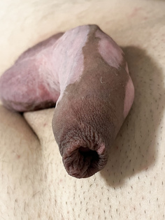 Vitiligo Penis schlaff / halbschlaff