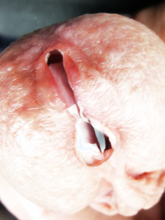 Dilator, wo das Sperma sprudeln kann