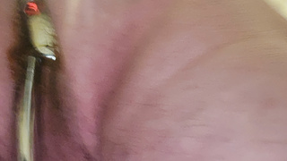 Analhaken mit Dillator