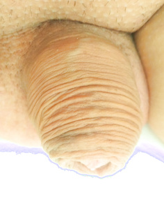Kleiner Micropenis Bilder
